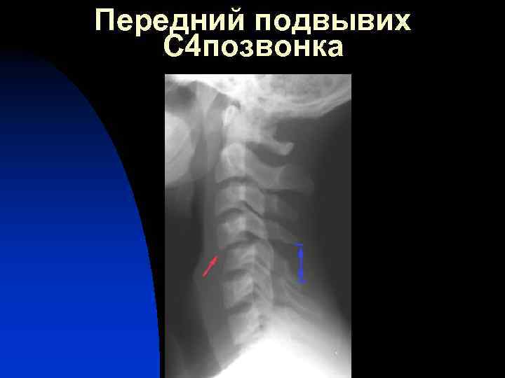 Подвывих позвонка. Подвывих шейного позвонка рентген. Подвывих поясничного позвонка на рентгене. Подвывих 4 позвонка. Вывих с4 позвонка.