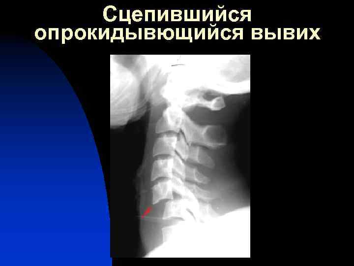 Сцепившийся опрокидывющийся вывих 