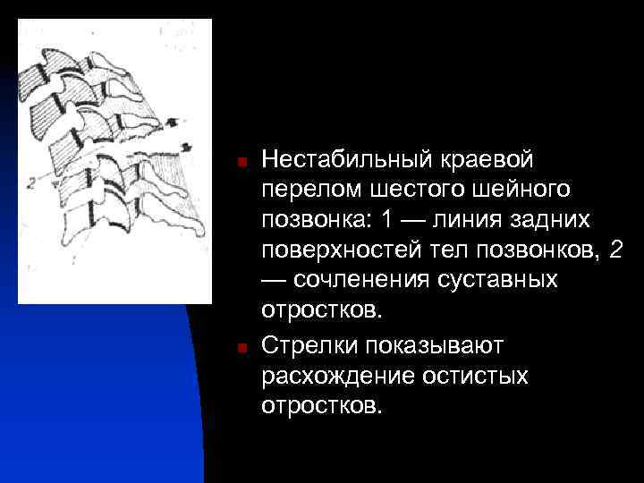 n n Нестабильный краевой перелом шестого шейного позвонка: 1 — линия задних поверхностей тел