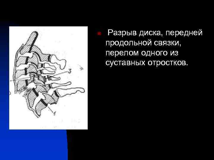 n Разрыв диска, передней продольной связки, перелом одного из суставных отростков. 