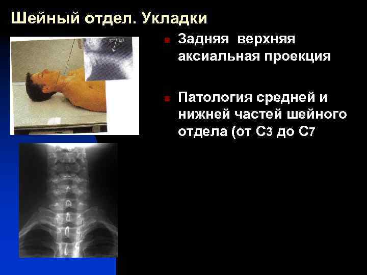 Шейный отдел. Укладки n n Задняя верхняя аксиальная проекция Патология средней и нижней частей