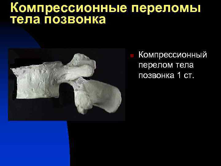 Компрессионные переломы тела позвонка n Компрессионный перелом тела позвонка 1 ст. 