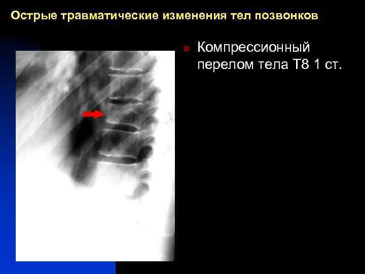 Острые травматические изменения тел позвонков n Компрессионный перелом тела Т 8 1 ст. 