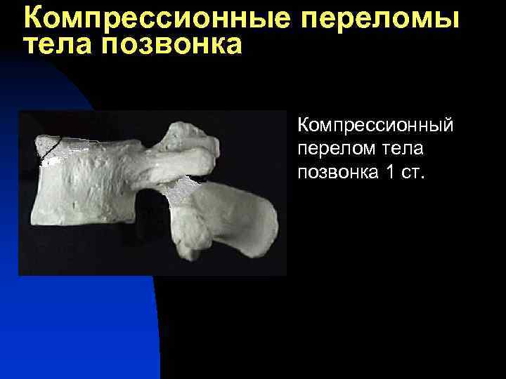 Компрессионные переломы тела позвонка n Компрессионный перелом тела позвонка 1 ст. 