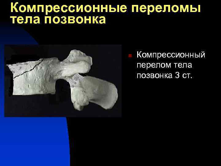Компрессионные переломы тела позвонка n Компрессионный перелом тела позвонка 3 ст. 