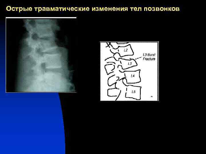 Острые травматические изменения тел позвонков 