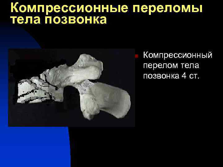 Компрессионные переломы тела позвонка n Компрессионный перелом тела позвонка 4 ст. 
