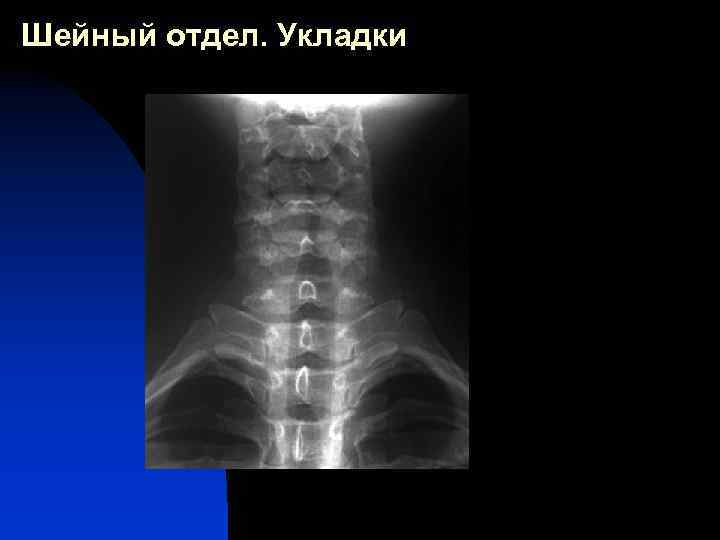 Шейный отдел. Укладки 
