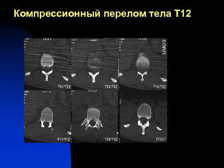 Компрессионный перелом тела Т 12 
