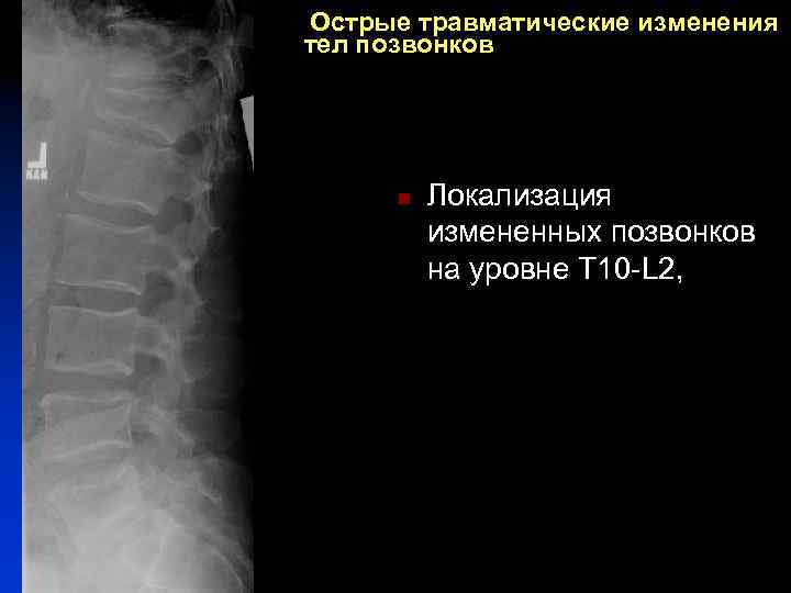 Острые травматические изменения тел позвонков n Локализация измененных позвонков на уровне Т 10 -L