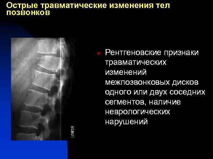 Острые травматические изменения тел позвонков n Рентгеновские признаки травматических изменений межпозвонковых дисков одного или