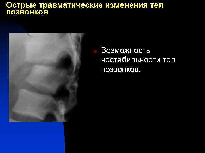 Острые травматические изменения тел позвонков n Возможность нестабильности тел позвонков. 
