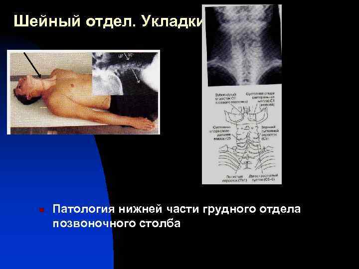 Шейный отдел. Укладки n Патология нижней части грудного отдела позвоночного столба 