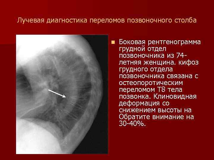 Лучевая диагностика переломов позвоночного столба n Боковая рентгенограмма грудной отдел позвоночника из 74 летняя