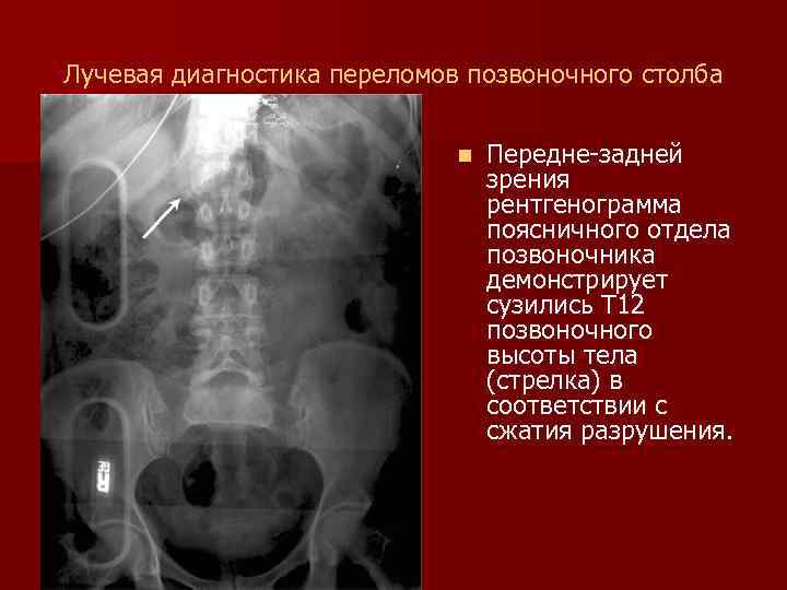 Лучевая диагностика переломов позвоночного столба n Передне-задней зрения рентгенограмма поясничного отдела позвоночника демонстрирует сузились