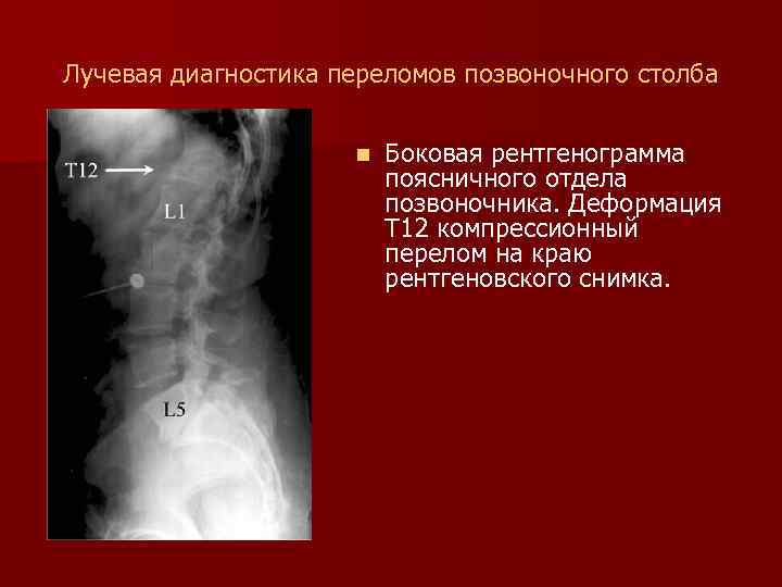 Лучевая диагностика переломов позвоночного столба n Боковая рентгенограмма поясничного отдела позвоночника. Деформация Т 12