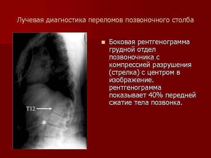 Лучевая диагностика переломов позвоночного столба n Боковая рентгенограмма грудной отдел позвоночника с компрессией разрушения