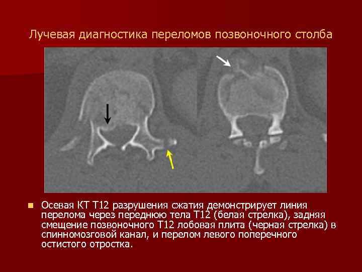 Лучевая диагностика переломов позвоночного столба n Осевая КТ T 12 разрушения сжатия демонстрирует линия