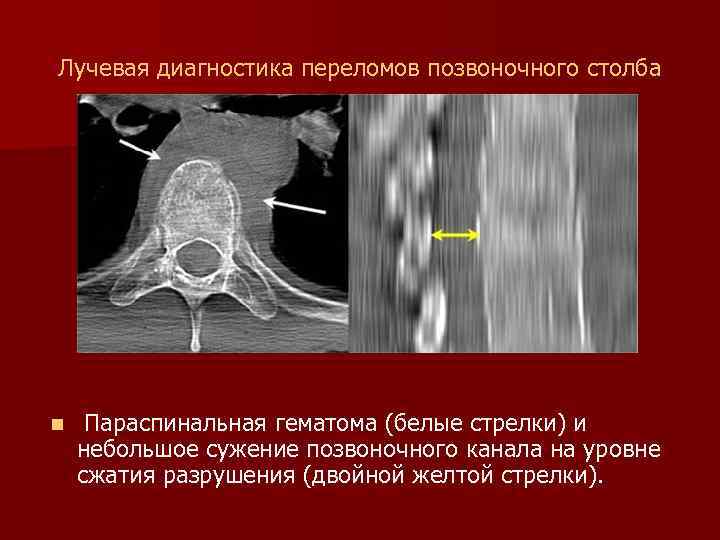 Лучевая диагностика переломов позвоночного столба n Параспинальная гематома (белые стрелки) и небольшое сужение позвоночного