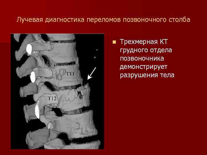 Лучевая диагностика переломов позвоночного столба n Трехмерная КТ грудного отдела позвоночника демонстрирует разрушения тела