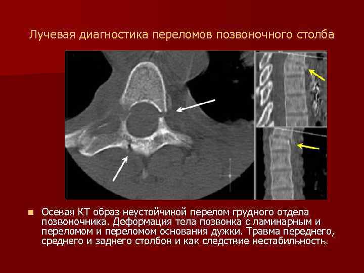 Лучевая диагностика переломов позвоночного столба n Осевая КТ образ неустойчивой перелом грудного отдела позвоночника.