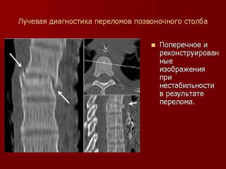 Лучевая диагностика переломов позвоночного столба n Поперечное и реконструирован ные изображения при нестабильности в