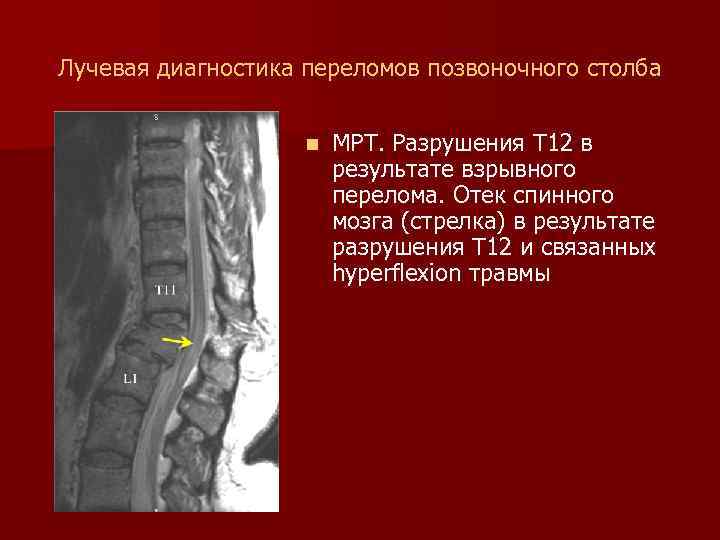 Лучевая диагностика переломов позвоночного столба n МРТ. Разрушения T 12 в результате взрывного перелома.