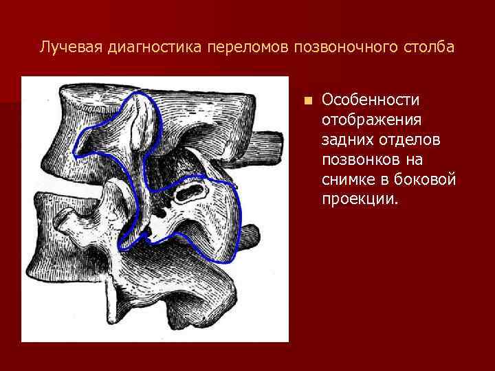 Лучевая диагностика переломов позвоночного столба n Особенности отображения задних отделов позвонков на снимке в