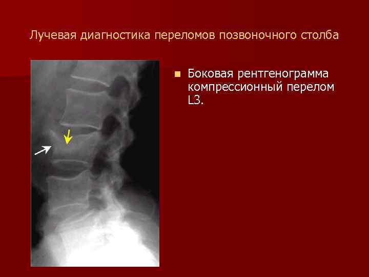 Лучевая диагностика переломов позвоночного столба n Боковая рентгенограмма компрессионный перелом L 3. 