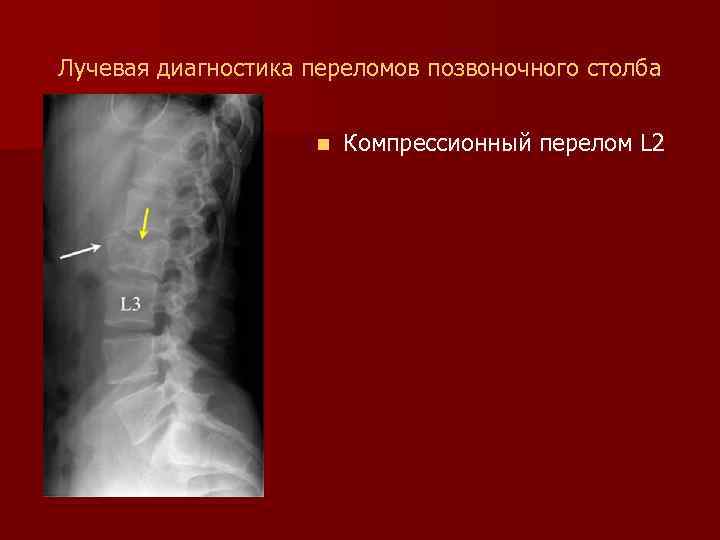 Лучевая диагностика переломов позвоночного столба n Компрессионный перелом L 2 