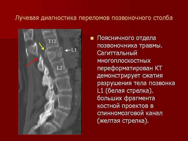 Лучевая диагностика переломов позвоночного столба n Поясничного отдела позвоночника травмы. Сагиттальный многоплоскостных переформатирован КТ