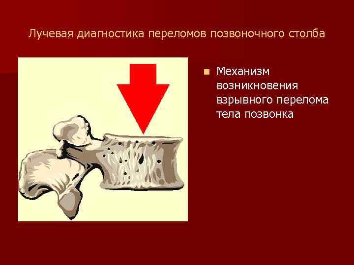 Лучевая диагностика переломов позвоночного столба n Механизм возникновения взрывного перелома тела позвонка 