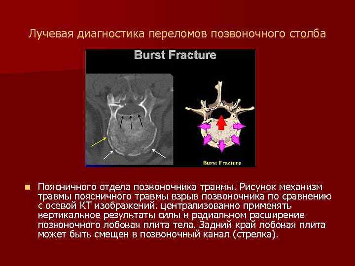 Лучевая диагностика переломов позвоночного столба n Поясничного отдела позвоночника травмы. Рисунок механизм травмы поясничного