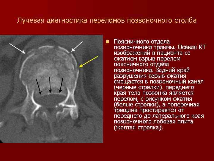 Лучевая диагностика переломов позвоночного столба n Поясничного отдела позвоночника травмы. Осевая КТ изображений в