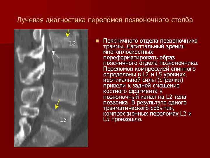 Диагноз перелом. Сагиттальный размер позвоночного канала поясничного отдела. Сагиттальный размер тела позвонка. Лучевая диагностика перелом позвонка. Рентгенодиагностика поясничного отдела позвоночника.