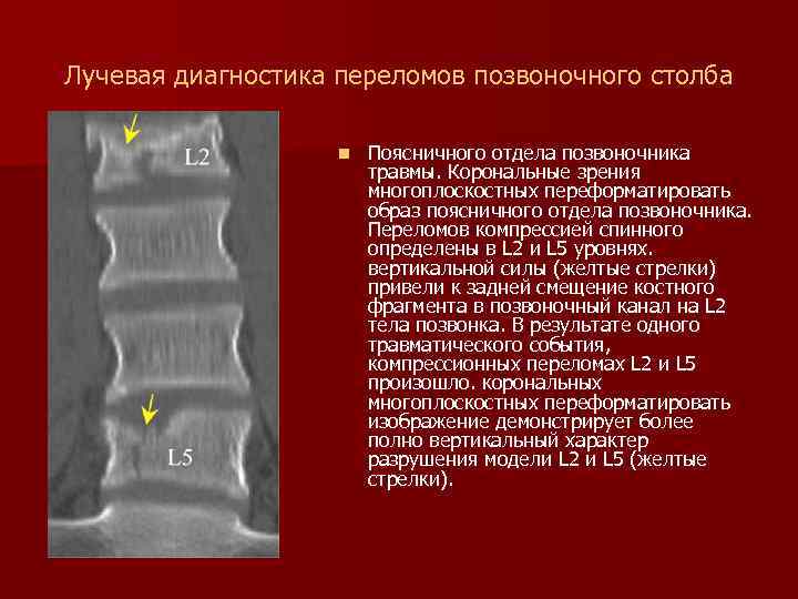 Лучевая диагностика переломов позвоночного столба n Поясничного отдела позвоночника травмы. Корональные зрения многоплоскостных переформатировать