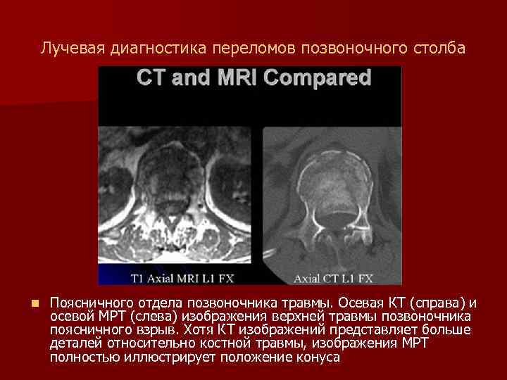 Лучевая диагностика переломов позвоночного столба n Поясничного отдела позвоночника травмы. Осевая КТ (справа) и