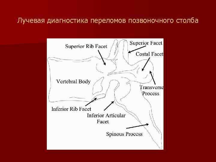 Лучевая диагностика переломов позвоночного столба 