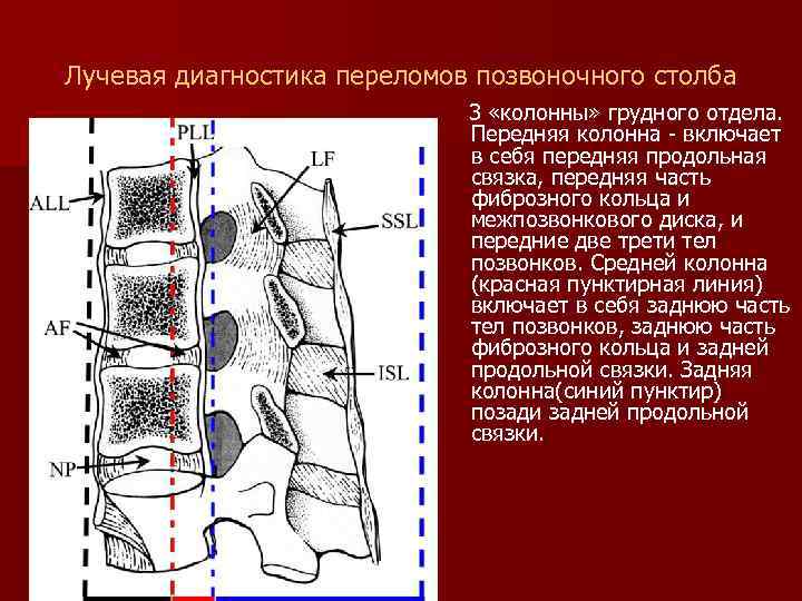 Лучевая диагностика переломов позвоночного столба 3 «колонны» грудного отдела. Передняя колонна - включает в