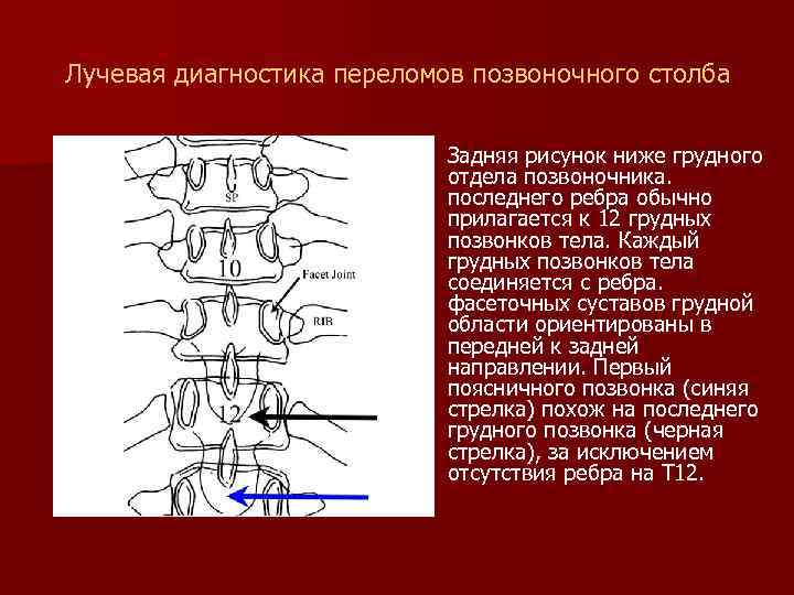 Лучевая диагностика переломов позвоночного столба n Задняя рисунок ниже грудного отдела позвоночника. последнего ребра