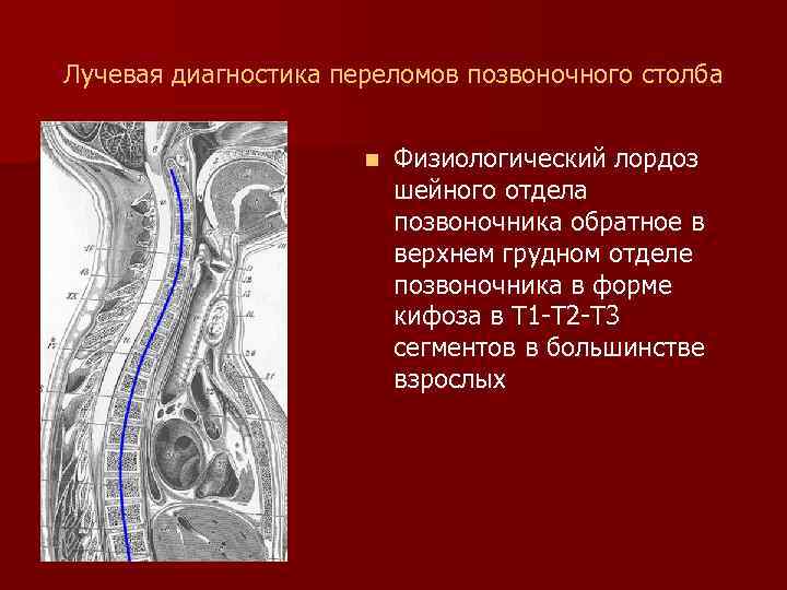 Лучевая диагностика переломов позвоночного столба n Физиологический лордоз шейного отдела позвоночника обратное в верхнем