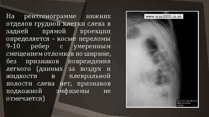 На рентгенограмме нижних отделов грудной клетки слева в задней прямой проекции определяется - косые