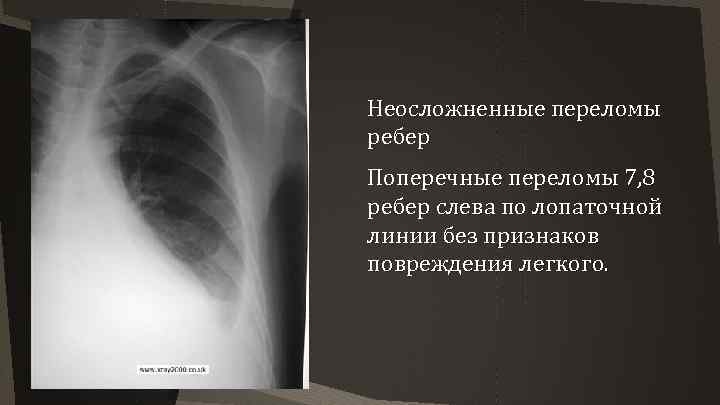 Неосложненные переломы ребер Поперечные переломы 7, 8 ребер слева по лопаточной линии без признаков