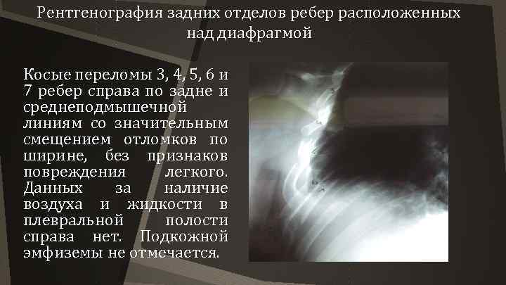 Рентгенография задних отделов ребер расположенных над диафрагмой Косые переломы 3, 4, 5, 6 и