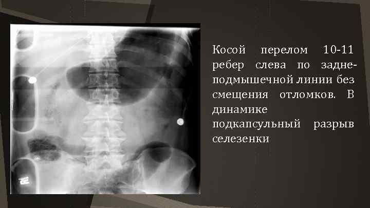 Перелом 9 10 ребра. Карта СМП перелом ребер. Подкапсульный разрыв селезенки.