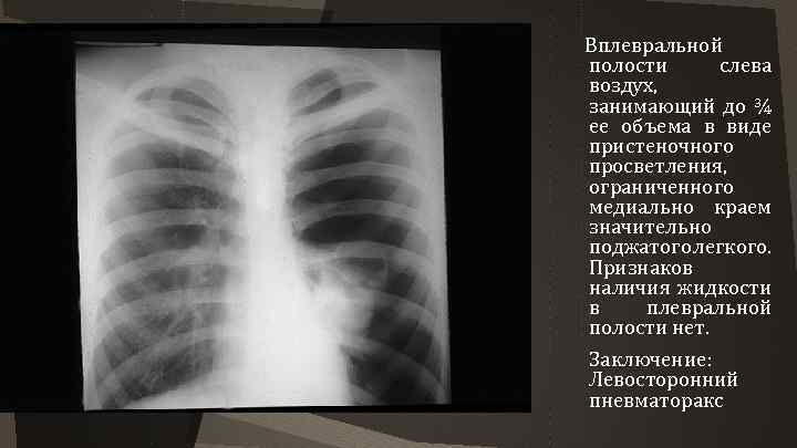 Вплевральной полости слева воздух, занимающий до ¾ ее объема в виде пристеночного просветления, ограниченного