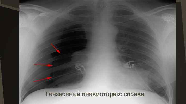 Тензионный пневмоторакс справа 