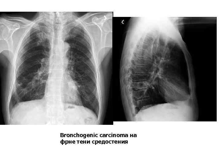 Bronchogenic carcinoma на фрне тени средостения 