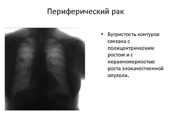 Клиническая картина периферического паралича