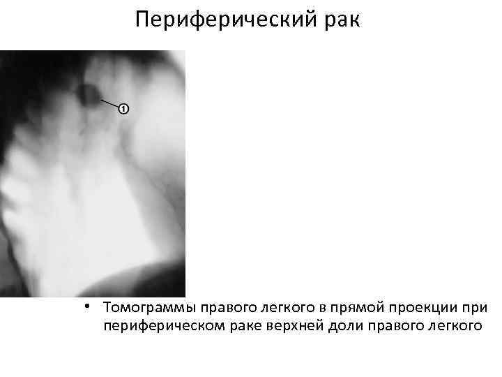 Периферический рак • Томограммы правого легкого в прямой проекции при периферическом раке верхней доли